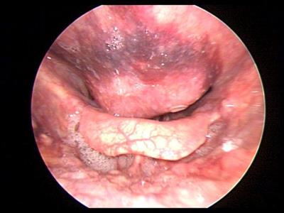 Cervical Hyperostosis Leading to Dyspnea, Aspiration and Dysphagia: Strategies to Improve Patient Management